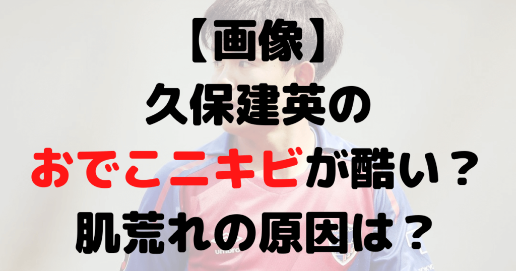 【画像】久保建英のおでこニキビが酷い？肌荒れの原因は？